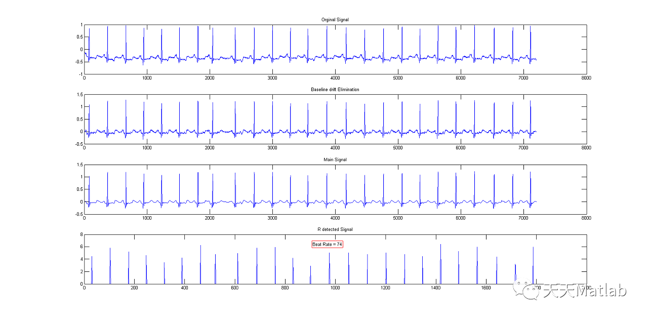 【医学】基于小波变换DWT实现ECG信号心率计算附matlab代码