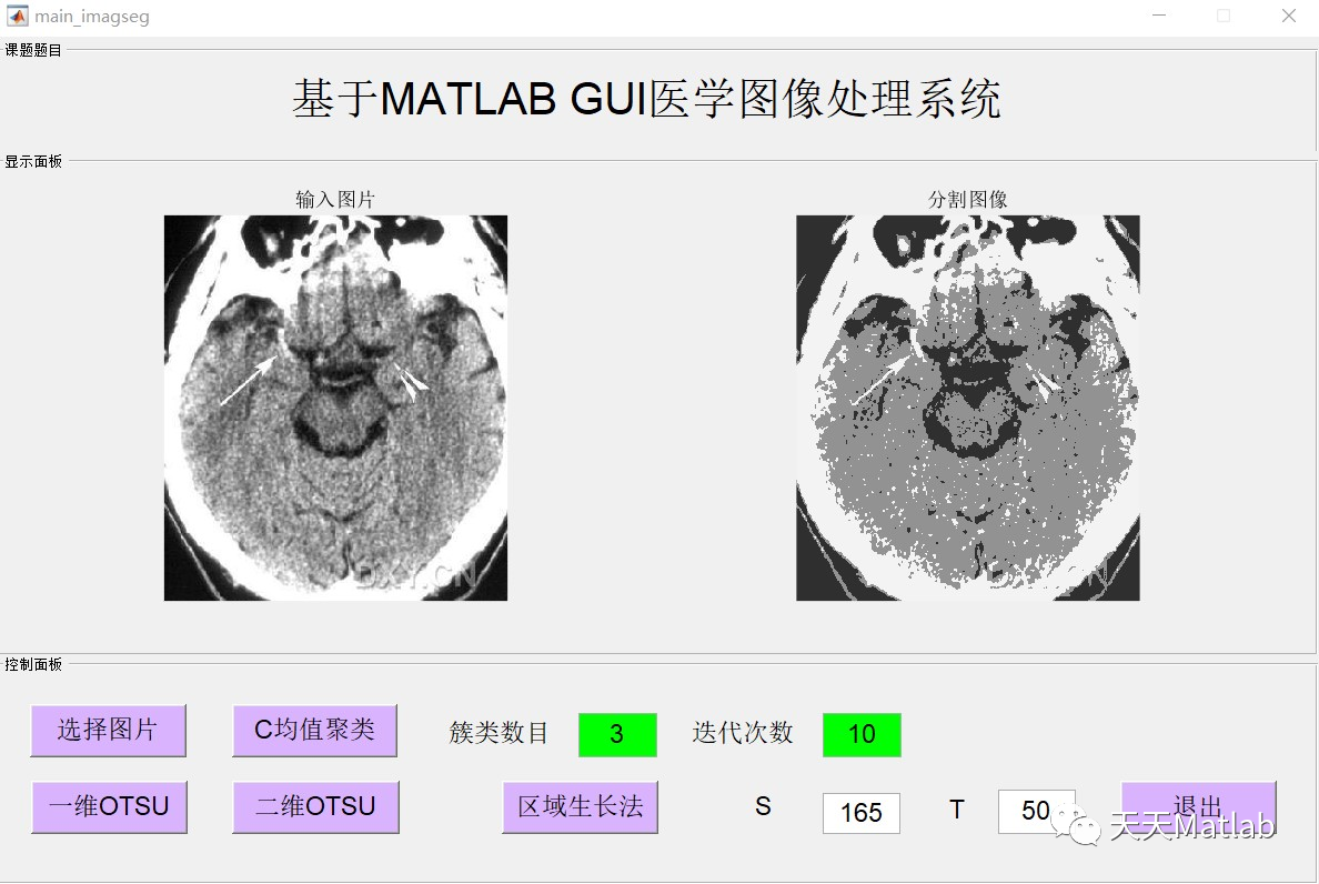 【图像分割】基于均值聚类+OUST+区域生长法实现MRI图像分割附matlab代码