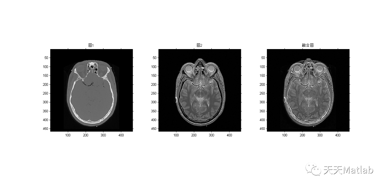 基于引导图像过滤器和图像统计实现MRI图像融合附matlab代码