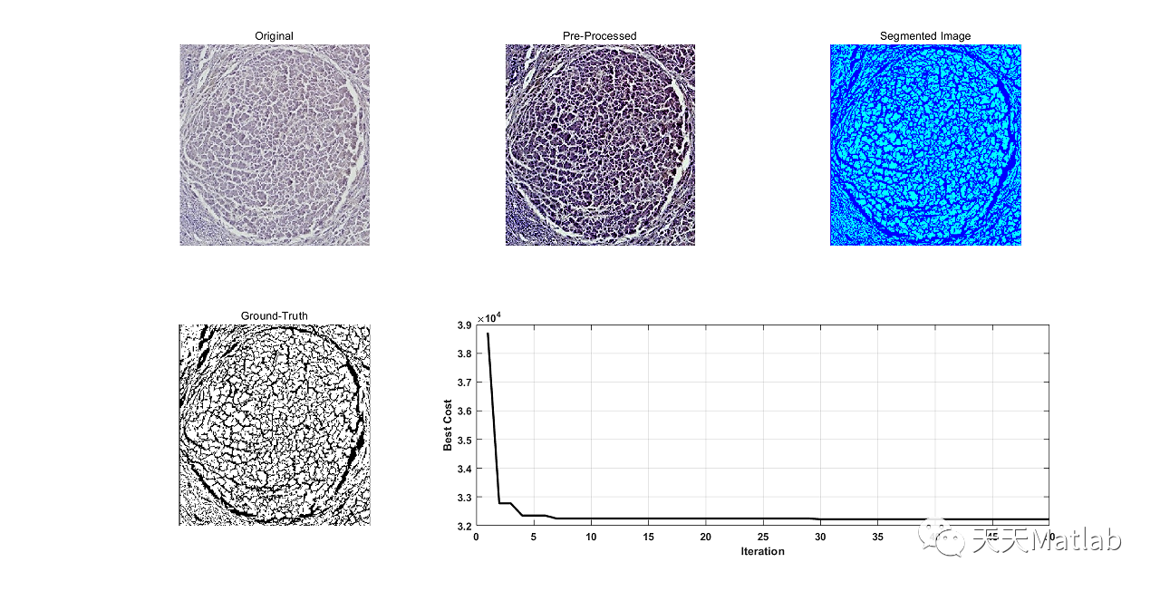 【图像分割】基于Kmean聚类 分水岭、oust、粒子群算法优化脂肪肝图像分割附matlab代码