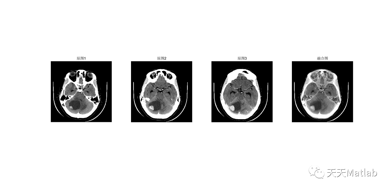 【图像融合】基于主成分结合小波离散变换PCA-DWT 的医学图像融合算法附matlab代码