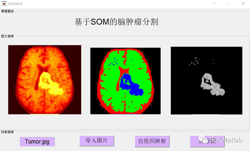 【图像检测】基于SOM实现脑肿瘤检测附matlab代码