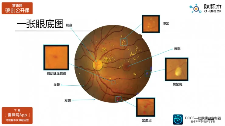 探讨医疗人工智能之眼科AI的真实应用场景（肽积木CEO柏文洁）丨硬创公开课