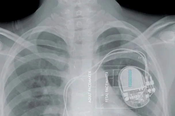 由于安全漏洞，美国联邦药物管理局召回465000个心脏起搏器