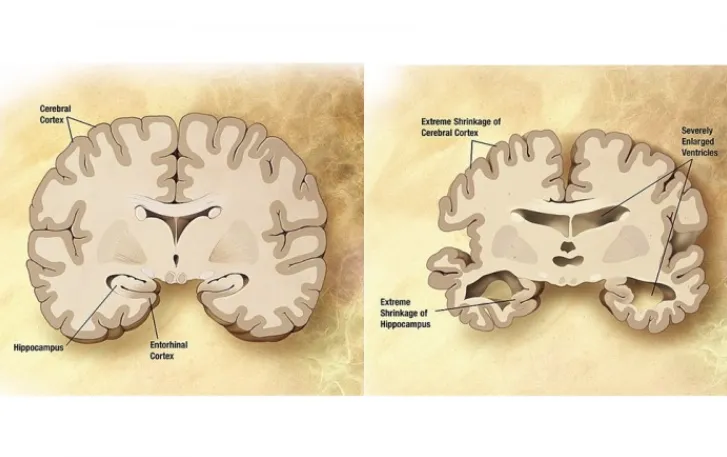 AI诊断又有新算法,让人们提前10年知道自己是否会老年痴呆