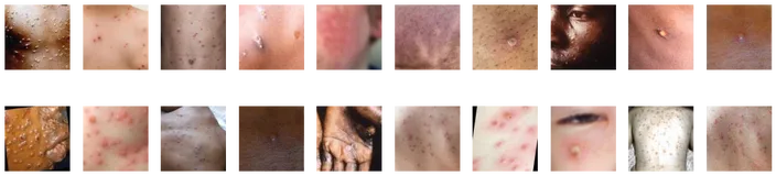 pytorch实现猴痘病识别