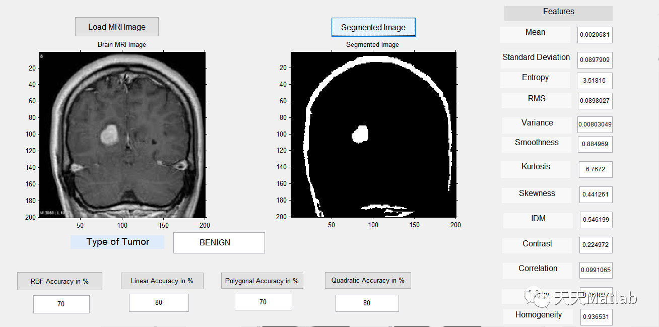 【图像检测】基于多种特征结合支持向量机实现脑 MRI 肿瘤检测和分类附Matlab 代码
