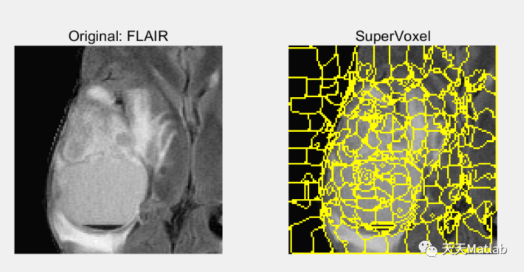 基于监督学习的多模态MRI脑肿瘤分割，使用来自超体素的纹理特征（Matlab代码实现）