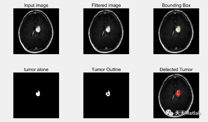 【图像处理】使用各向异性滤波器和分割图像处理从MRI图像检测脑肿瘤（Matlab代码实现）