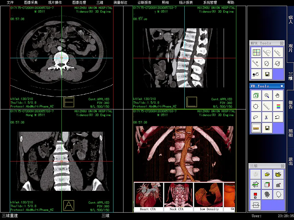 三维容积重建VRT.jpg