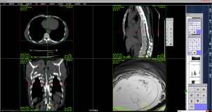医院PACS系统源码：CT后处理技术之仿真内镜CTVE