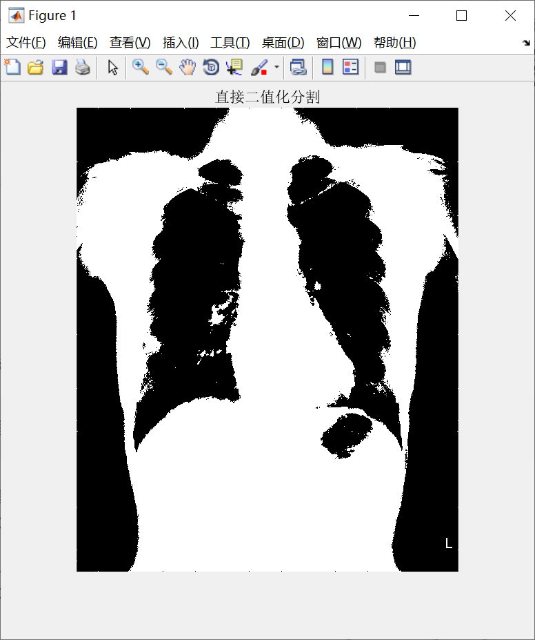 【深度学习】基于最小误差法的胸片分割系统（Matlab代码实现）