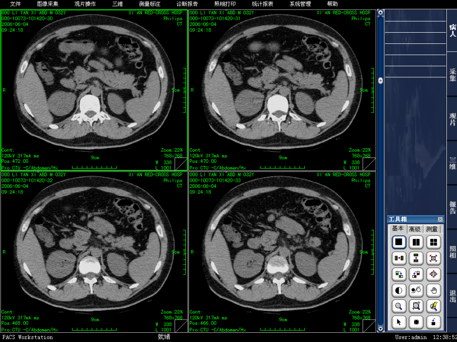 突破传统 重新定义:3d医学影像pacs系统源码(包含ris放射信息) 实现